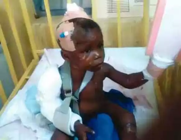 Photo: Step mother breaks arm, leg of 5 year old stepson in Ogun state